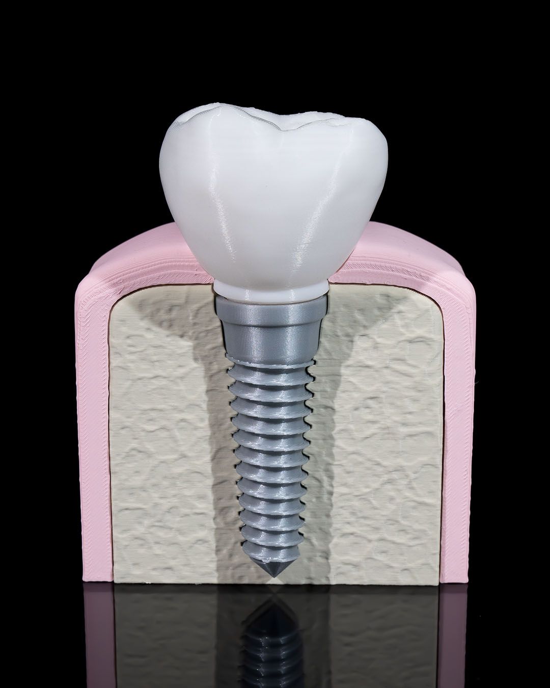 1332 - Dental Implant