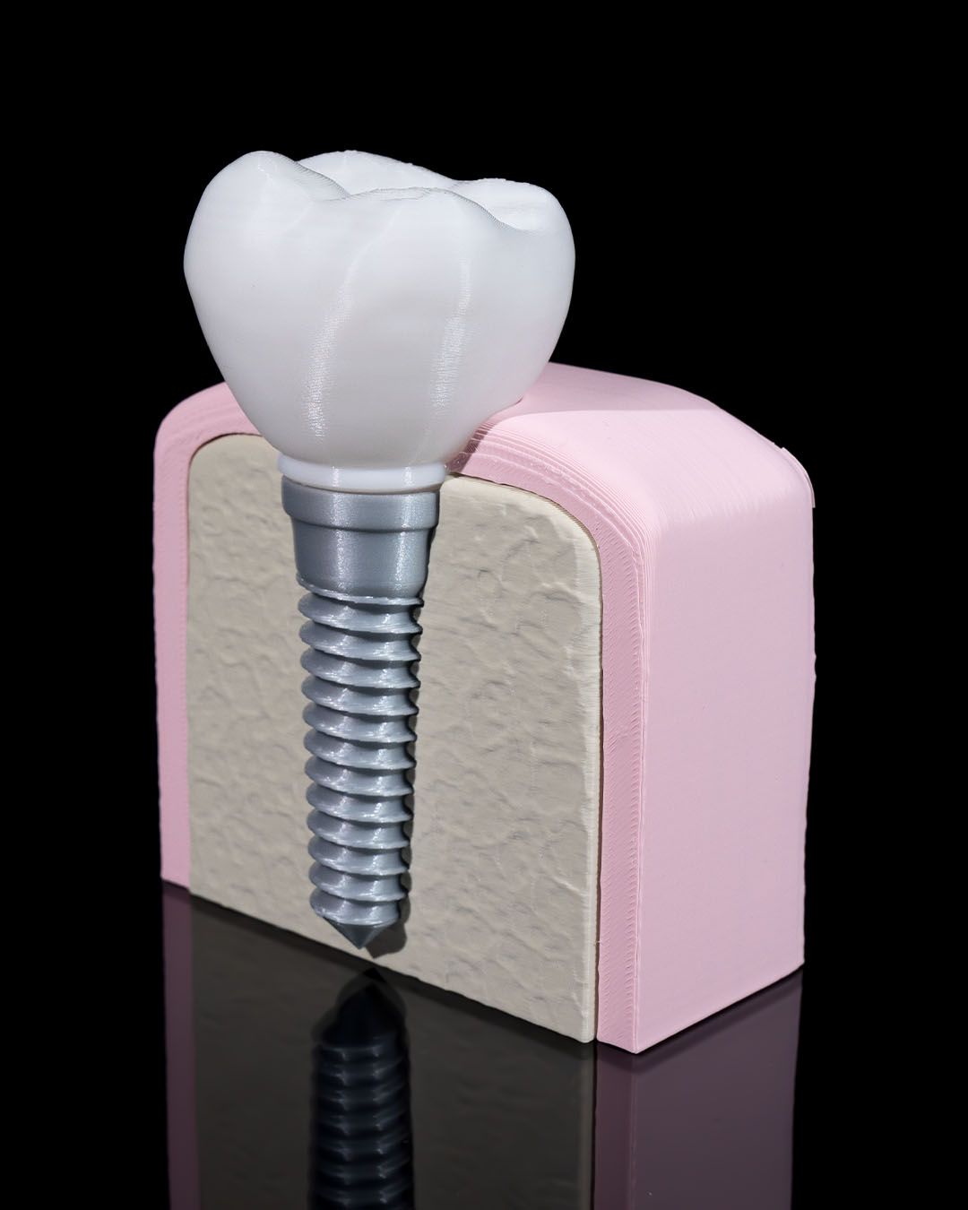 1332 - Dental Implant